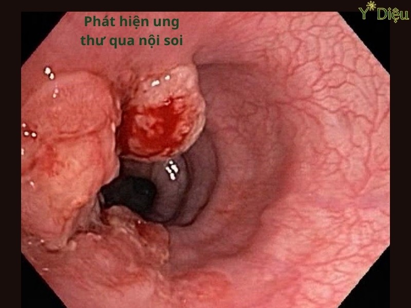 Triệu Chứng Ung Thư Dạ Dày: Nhận Biết Sớm Để Điều Trị